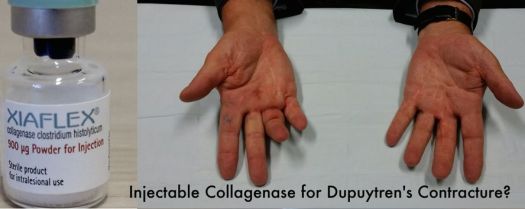 Collagenase for Dupuytren's by Dr Ian Yuen hand surgeon